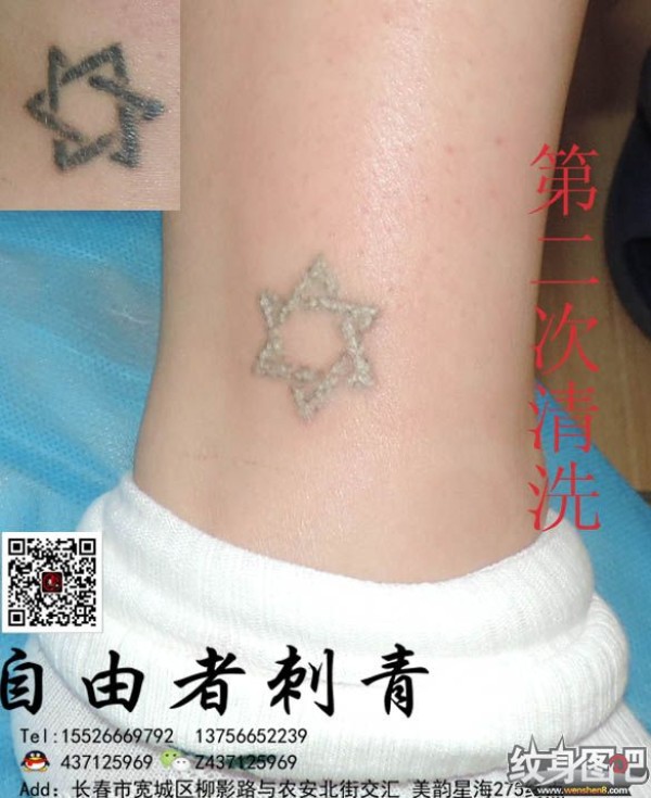 长春清洗纹身 长春自由者刺青