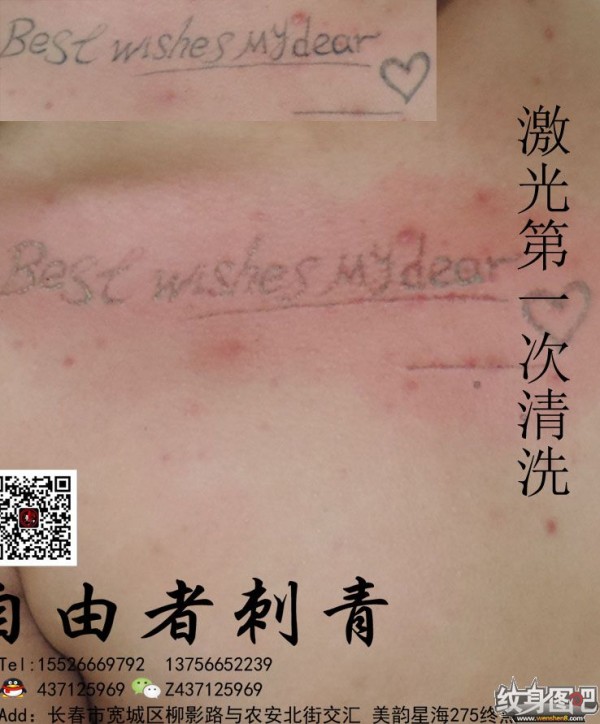 长春清洗纹身   长春自由者刺青