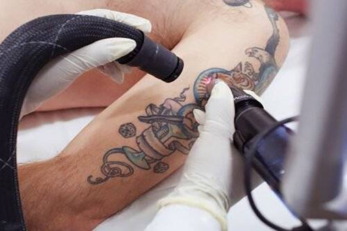 tattoo-removal4-2.jpg!800