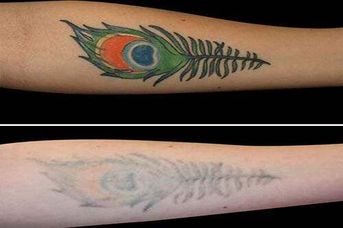 tattoo-removal2-2.jpg!800